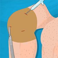 Operate Now: Knee Surgery